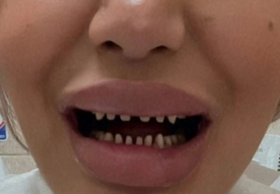 Turkey Teeth Gone Wrong