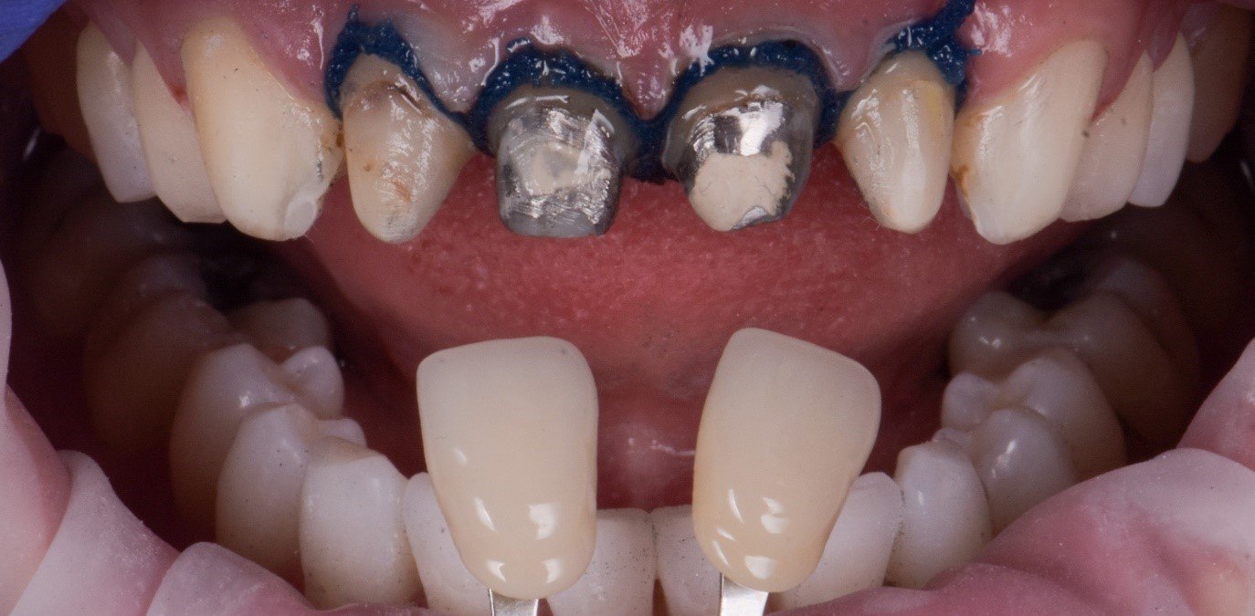 Turkey Teeth Gone Wrong